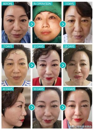 淡化泪沟有什么小技巧和方法,泪沟越来越明显是什么原因