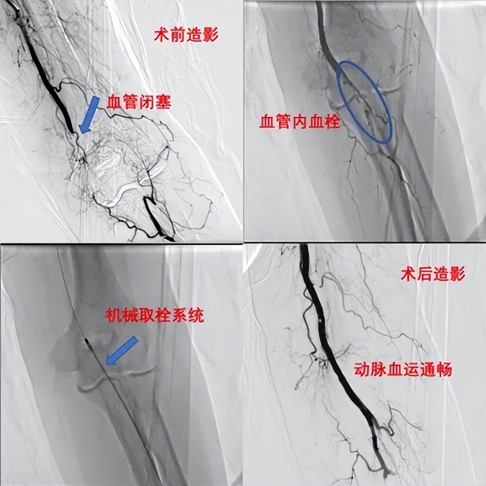 小血栓轻微堵塞血管,左上肢肱动脉血栓取栓手术