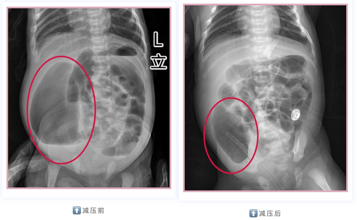 30天的小孩子肚子鼓鼓的硬硬的,儿童肚子胀得像大气球