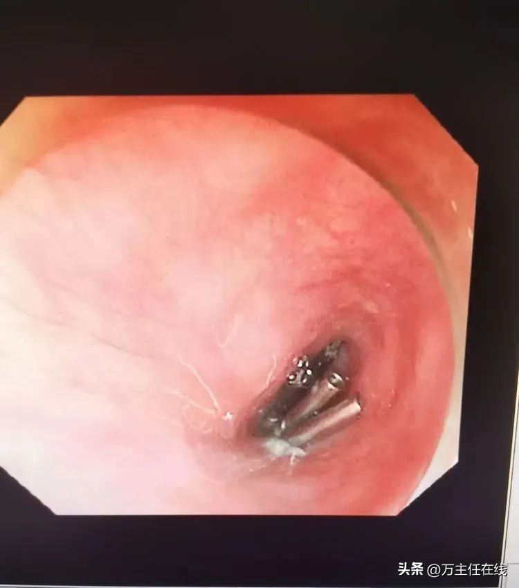 万荣教授上海市第一人民医院,消化内科专家手术