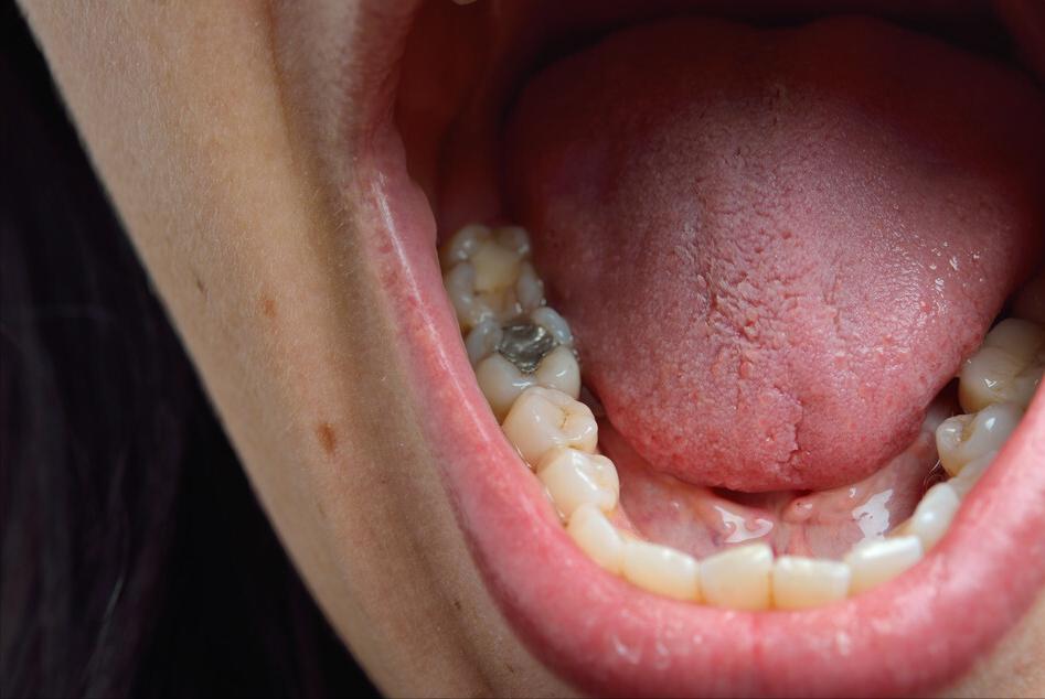 口腔疾病老是频发？可能跟糖尿病有关，日常预防需做好这5点