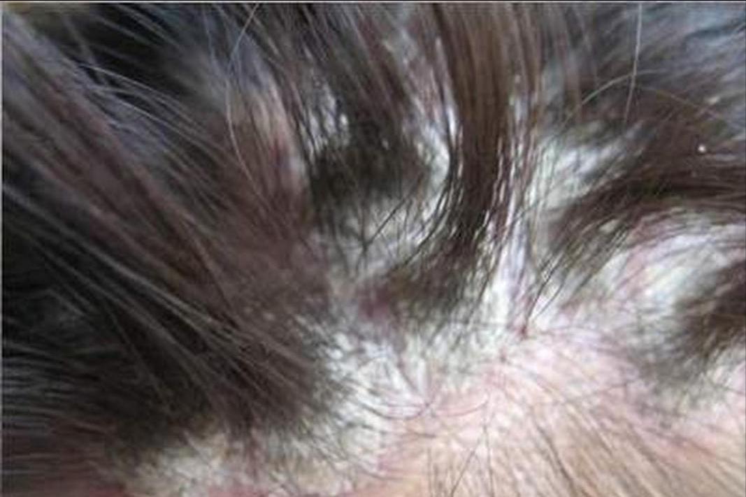 头皮长疙瘩和脓包怎么回事,头皮长脓包是怎么回事啊