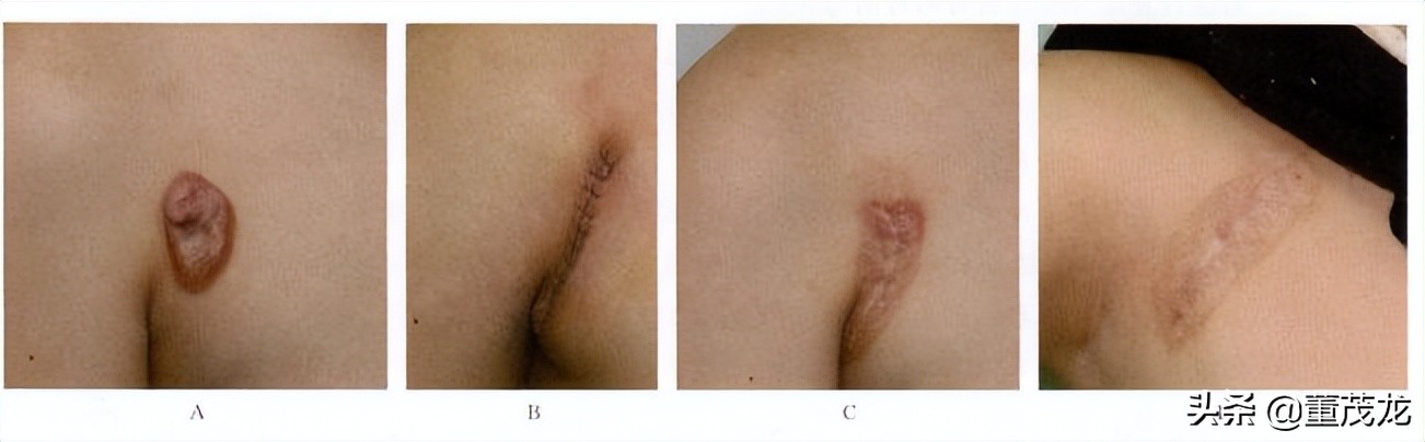 董茂龙说医:瘢痕的放射治疗
