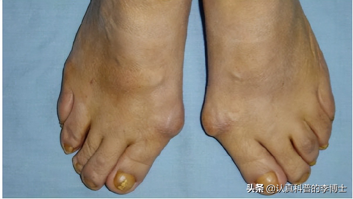 身体好不好就看鞋底,身体好不好看脚就知道