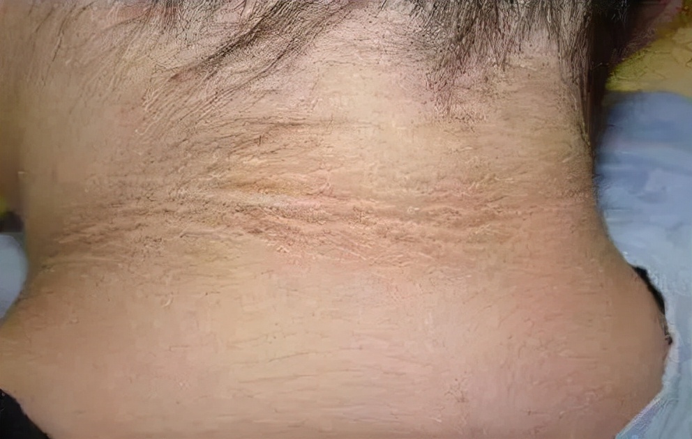 脖子黑一圈洗也洗不掉是怎么了,脖子上洗不干净黑黑的怎么办