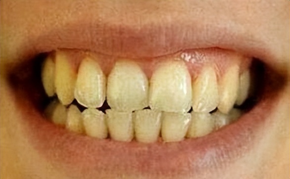戴牙套牙齿变黄怎么办？洗牙能不能美白牙齿？