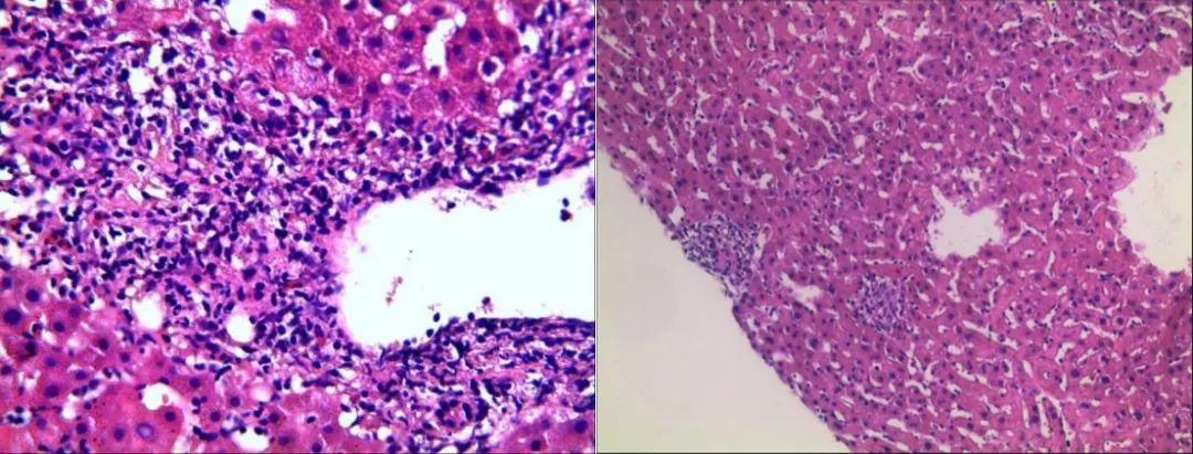 梅毒性肝炎吃什么药好,梅毒性肝炎的类型