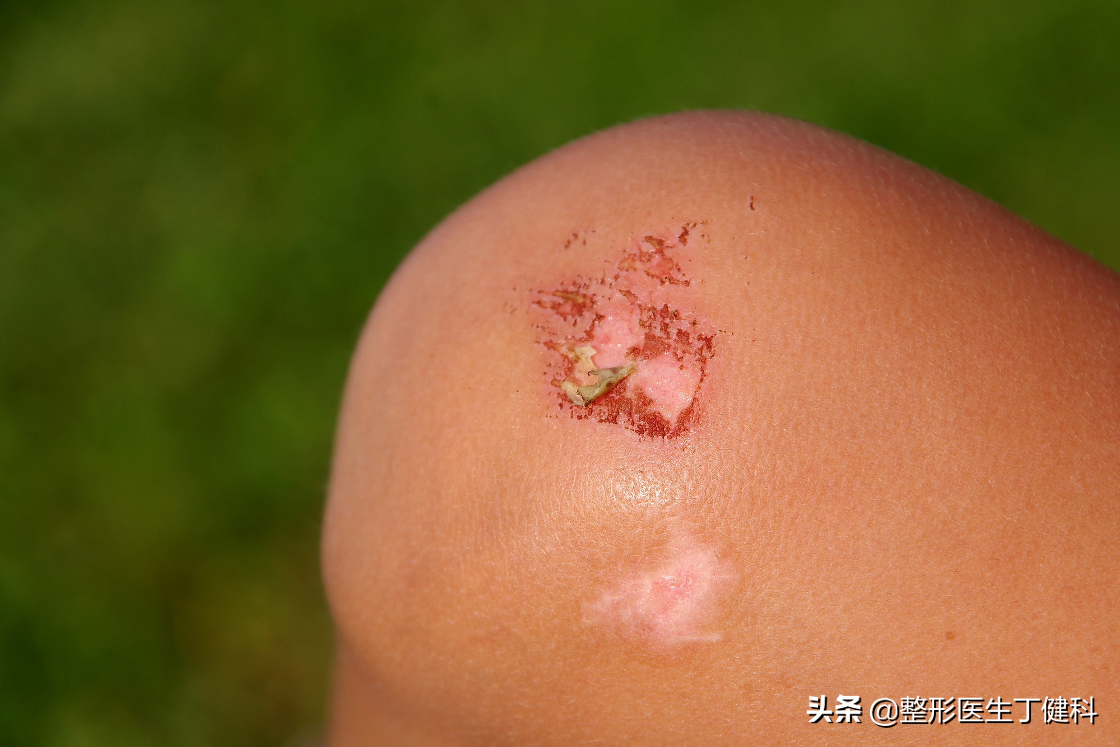 擦伤皮肤疤痕怎么能彻底消除,皮肤擦伤常见处理方法