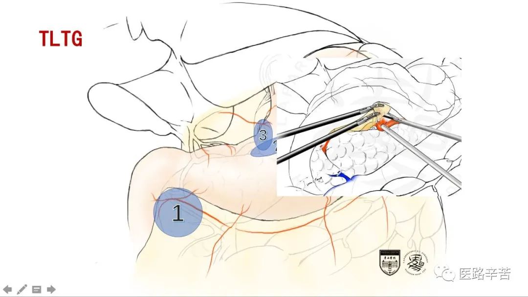全腹腔镜胃癌根治术，学习大咖怎么清扫淋巴结