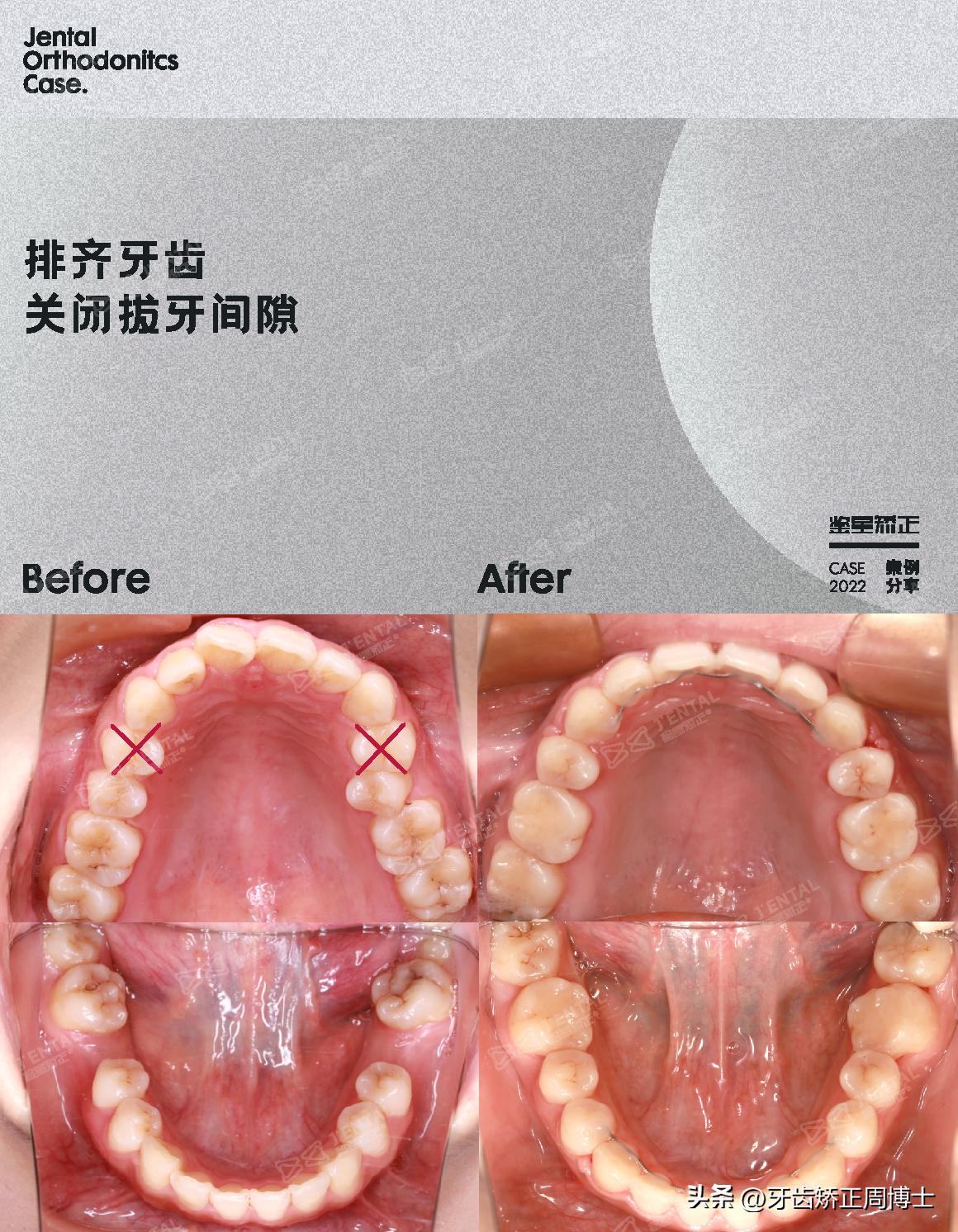 即刻种植即刻修复免受缺牙的痛苦,缺牙不补倾斜矫正价钱