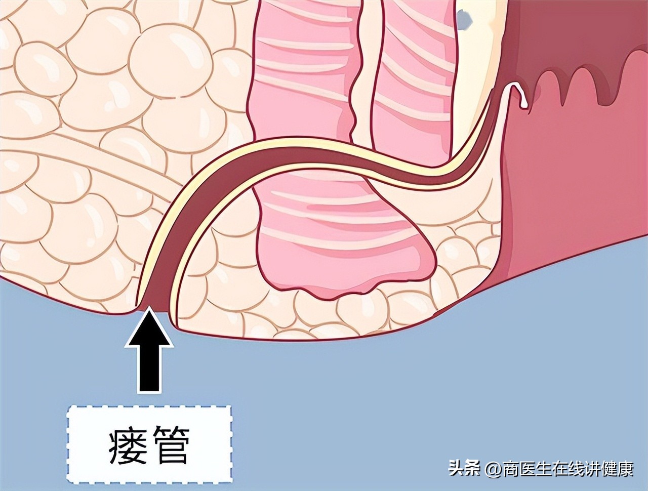 肛瘘手术快愈合了为什么有点痛,肛瘘引起脓肿不想手术