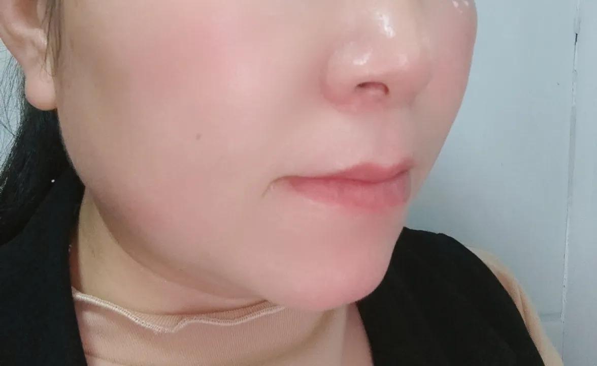 毛孔粗大形成坑怎么办,老化型毛孔粗大形成原因