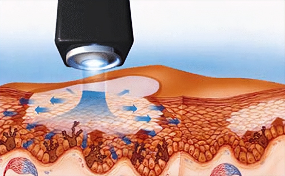 308nm准分子光白癜风治疗仪,308准分子激光治疗白癜风治愈率