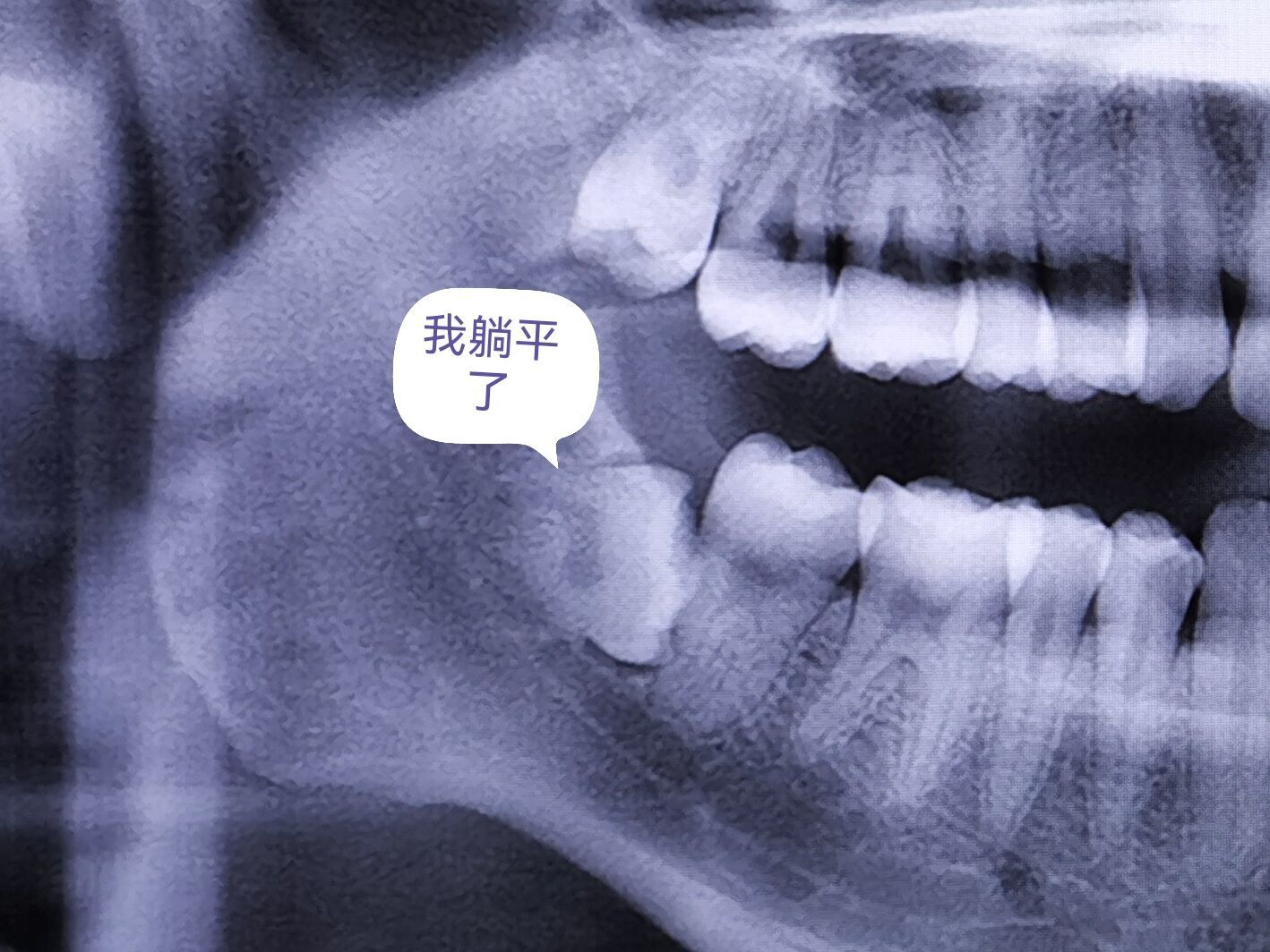 左下智齿拔除视频怎么正确拔除,复杂智齿拔除操作详细流程