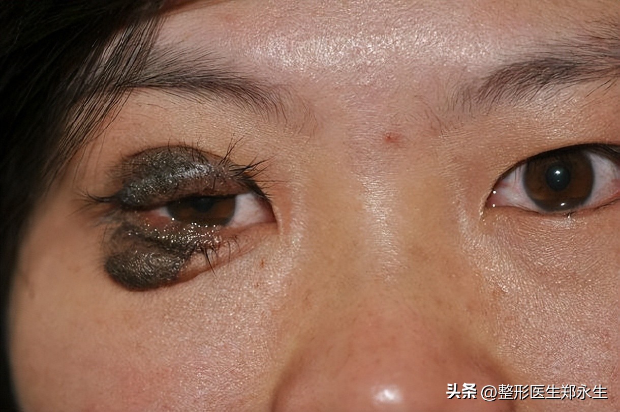 长在眼睛上的肿瘤,长在眼睛周围的痣