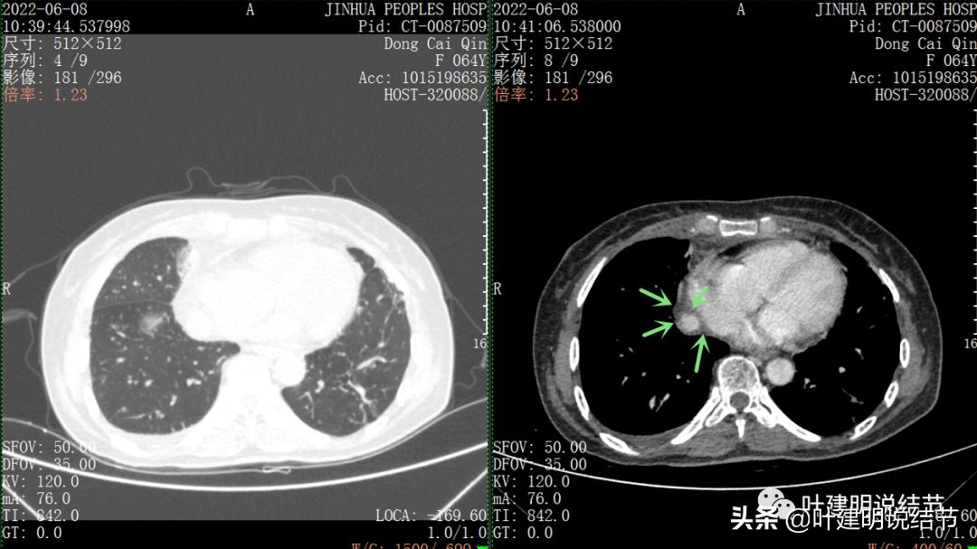 这位老乡，乏力来查，查出这么大个的纵隔肿瘤！会是什么呢？