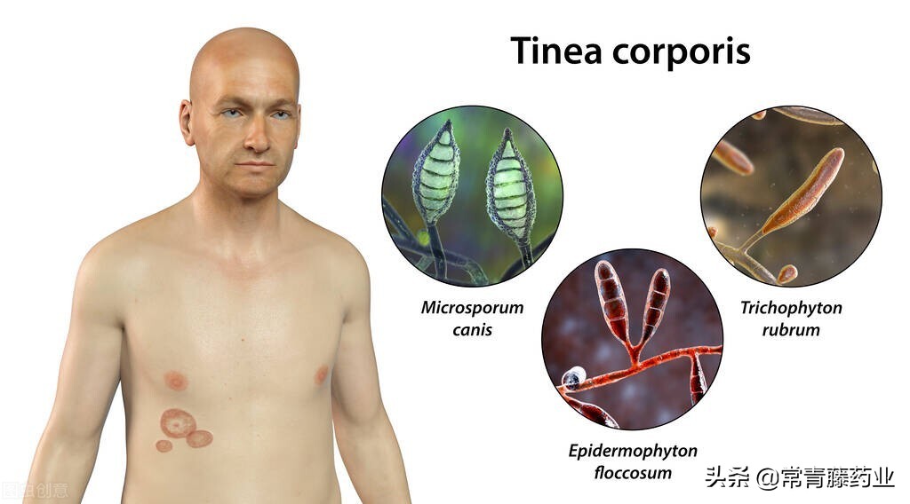 下体生癣要擦什么药膏好,霉菌一定要彻底清除吗