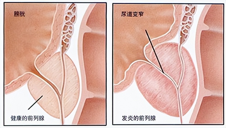 20岁小伙小便刺痛是怎么回事,尿频尿急小腹疼痛是咋回事怎么治