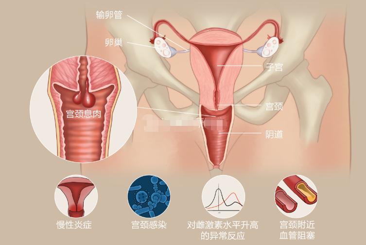 宫颈息肉是什么？宫颈息肉是怎么引起的？宫颈息肉会自动消失吗？