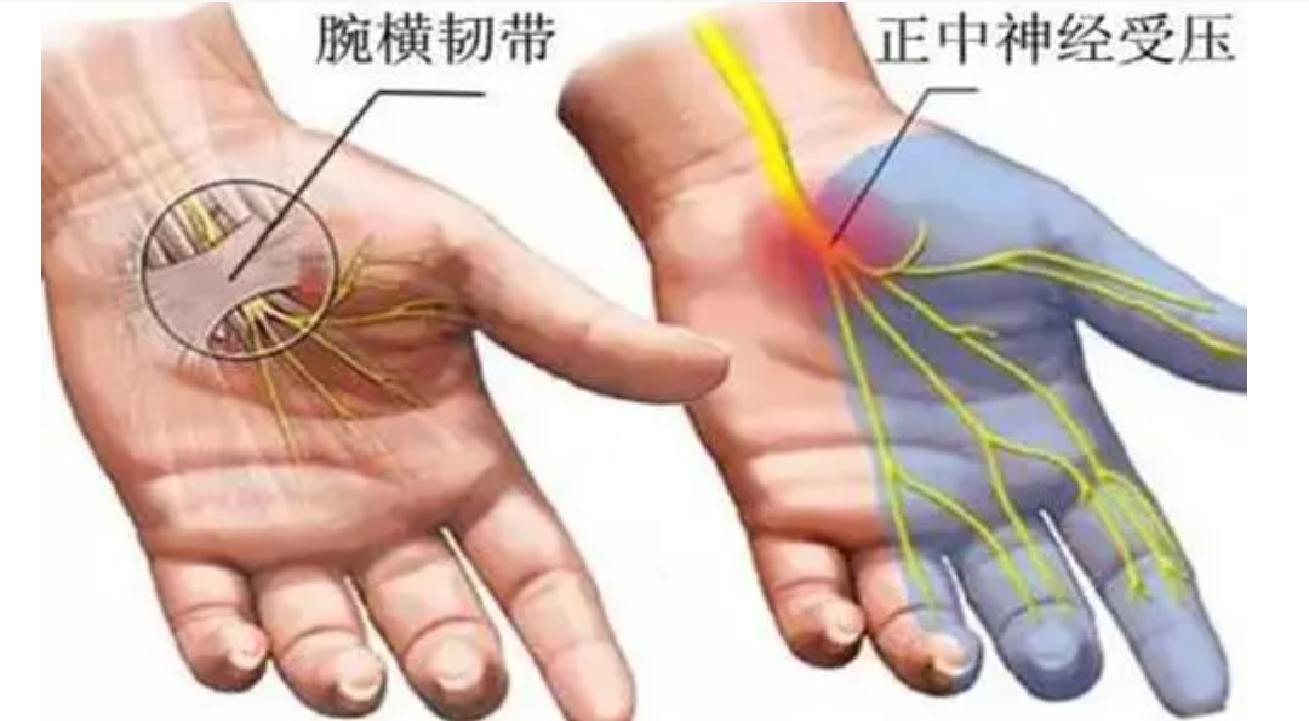 睡觉手指麻木醒来又恢复,手指麻木的最快解决办法