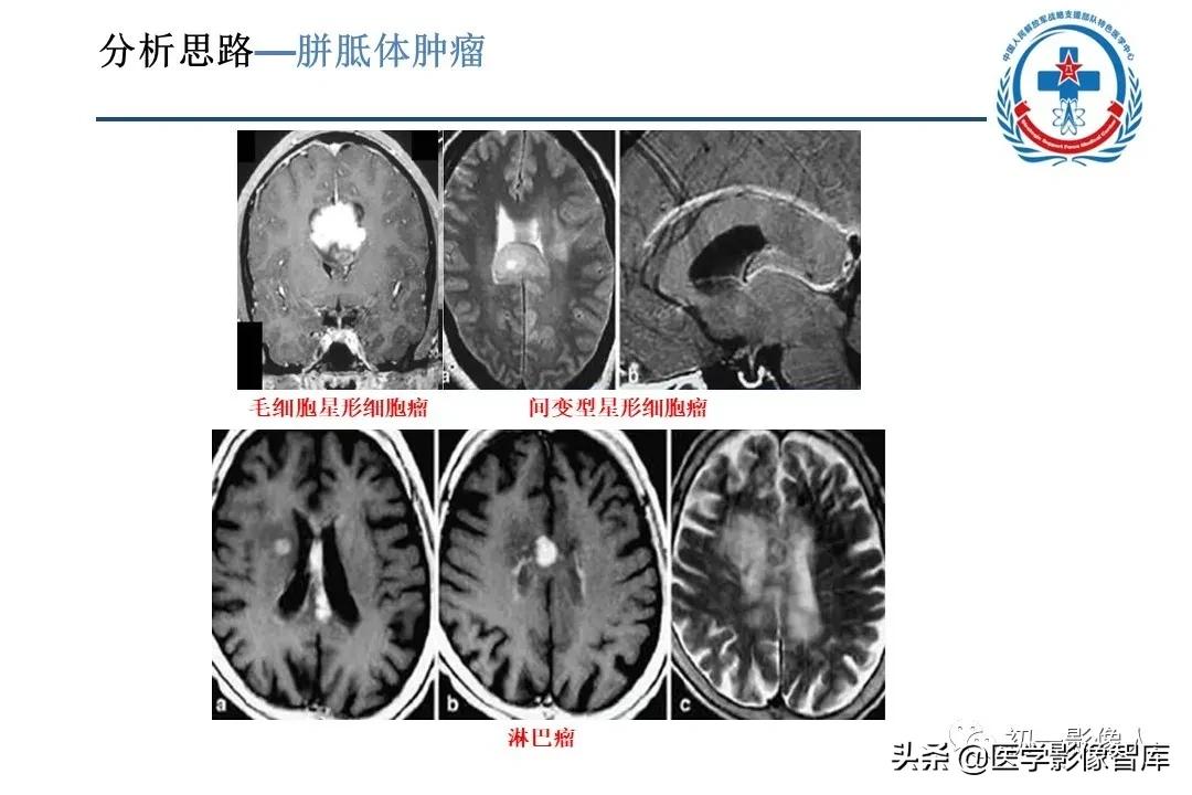 胼胝体变性治疗方法,原发性胼胝体病变治疗