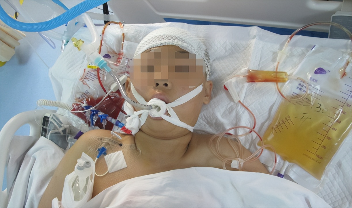 脑干出血儿童,儿童脑干胶质瘤呕吐