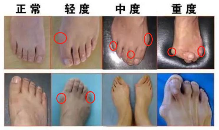 脚底板爱出脚汗怎么回事,脚底板爱紫是什么原因