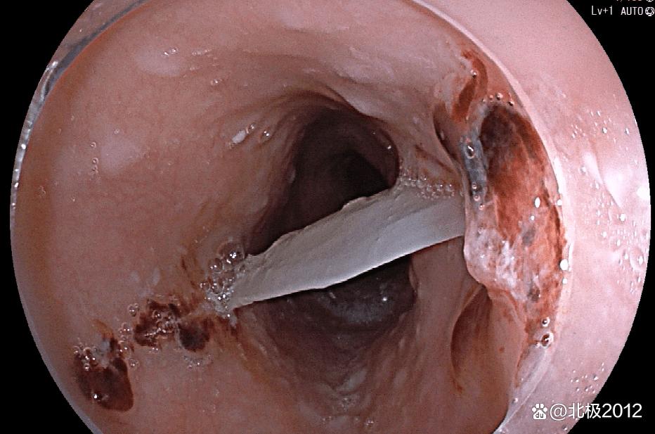 祸从口出如何解决,祸从口入吃什么食物