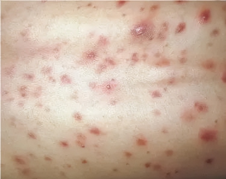 后背长毛囊炎怎么解决,后背长毛囊炎怎么彻底根治