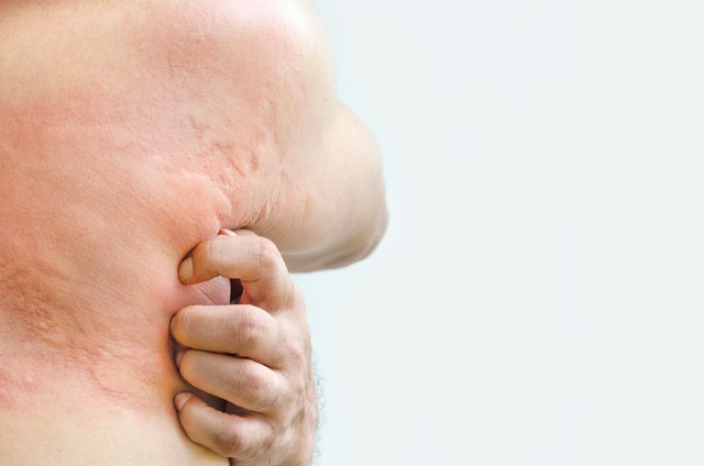 皮肤麻疹怎么止痒,荨麻疹等皮肤疾病的治疗秘方