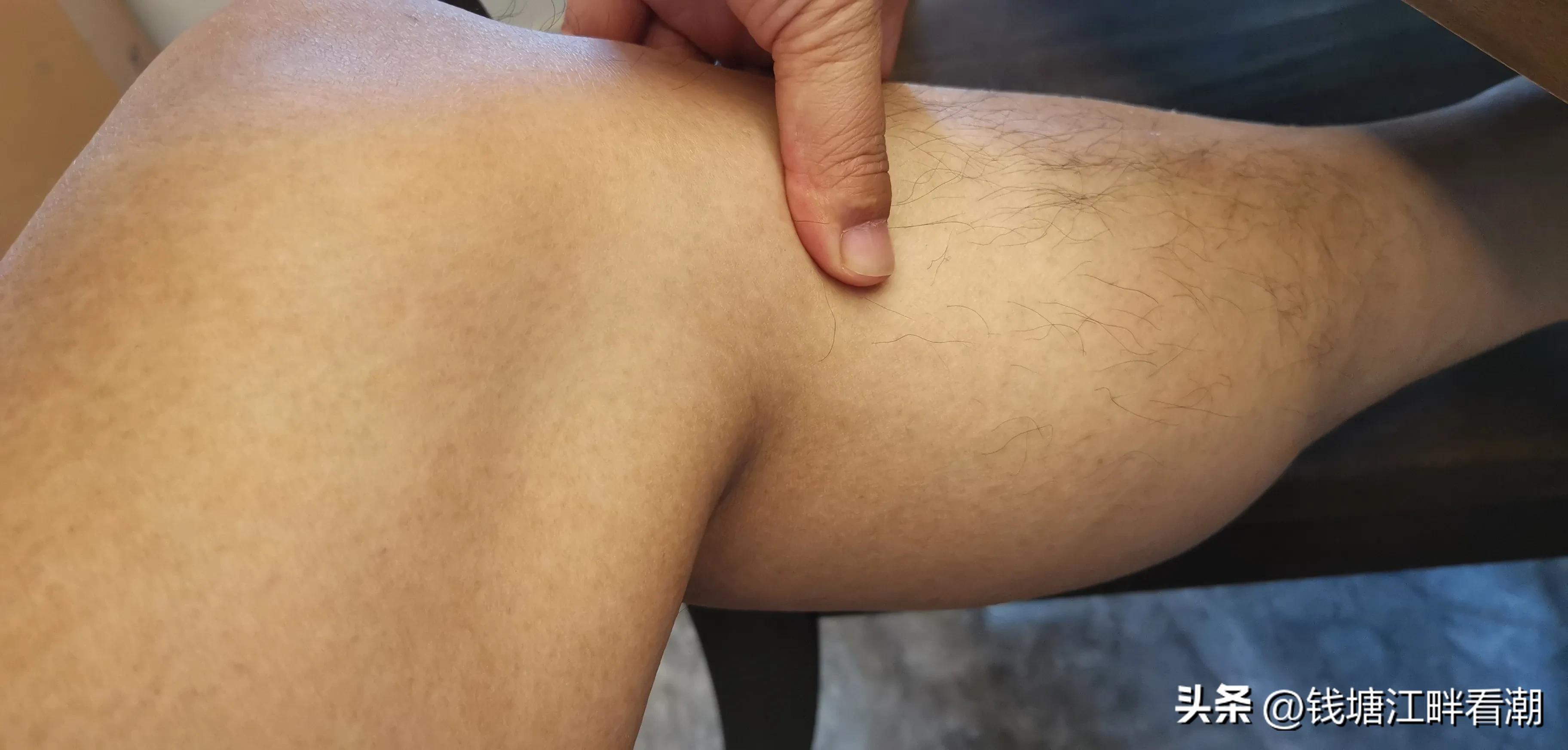 #不能这样活#（14）鹅足肌腱炎