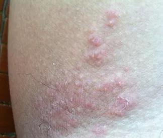 湿疹性皮炎能治好吗,参椒汤能治好湿疹吗