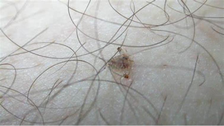 男子腹部痒,男性大量阴虱和虫卵