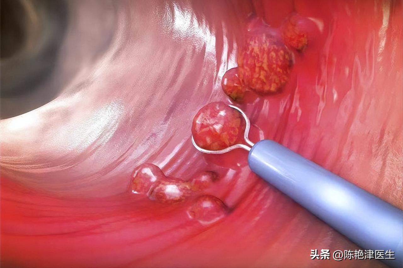 大肠癌治疗后肠息肉反复生长,息肉已经切除怎么还得大肠癌