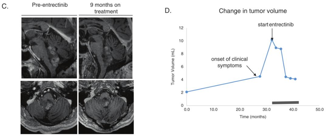 文献学习||靶向BCAN-NTRK1融合治疗脑胶质瘤的临床和影像学反应