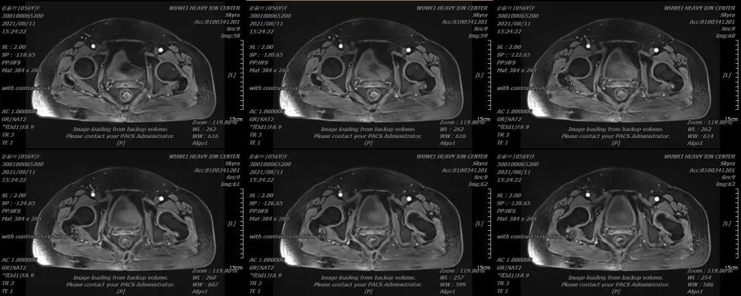 重离子治疗肿瘤效果怎么样,重离子治疗卵巢癌症
