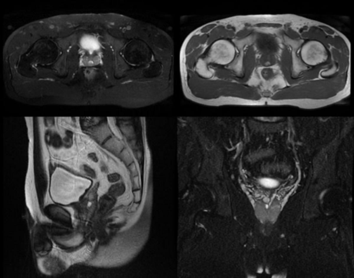 男性梗阻性无精症可以人工授精吗,男科梗阻性无精症