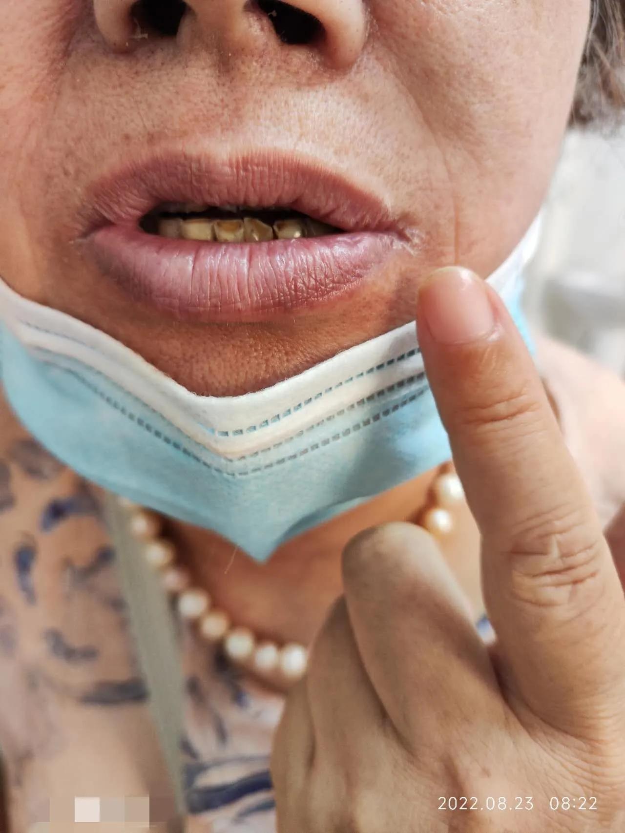 口服中药3个月，确诊5年的干燥综合征患者病情明显缓解