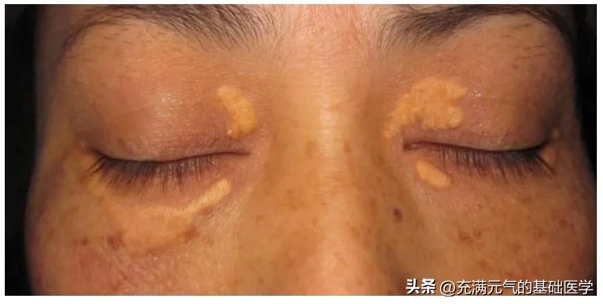 你见过吗，一些中年女性眼睑黄黄的两坨