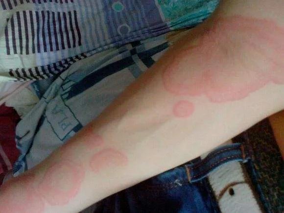 急性荨麻疹打一针就消了,急性荨麻疹打几天针能痊愈