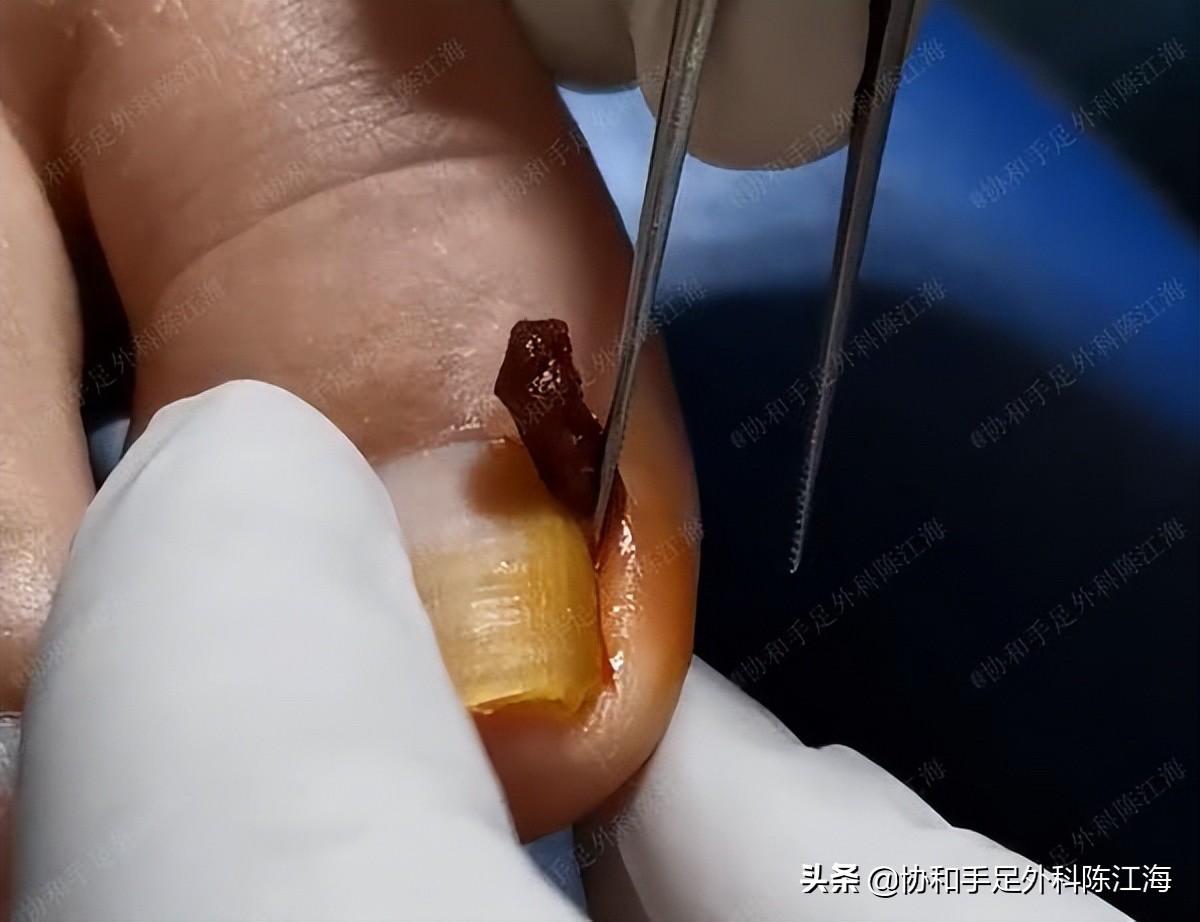 嵌甲怎么治疗才能彻底除根,嵌甲使用什么方法可以彻底根治