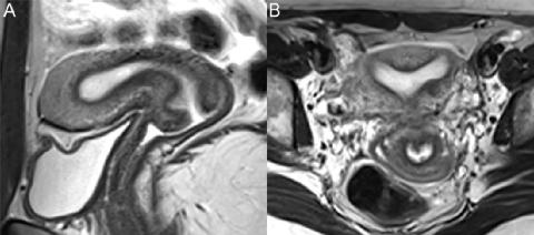 女性盆腔良性病变MR诊断要点