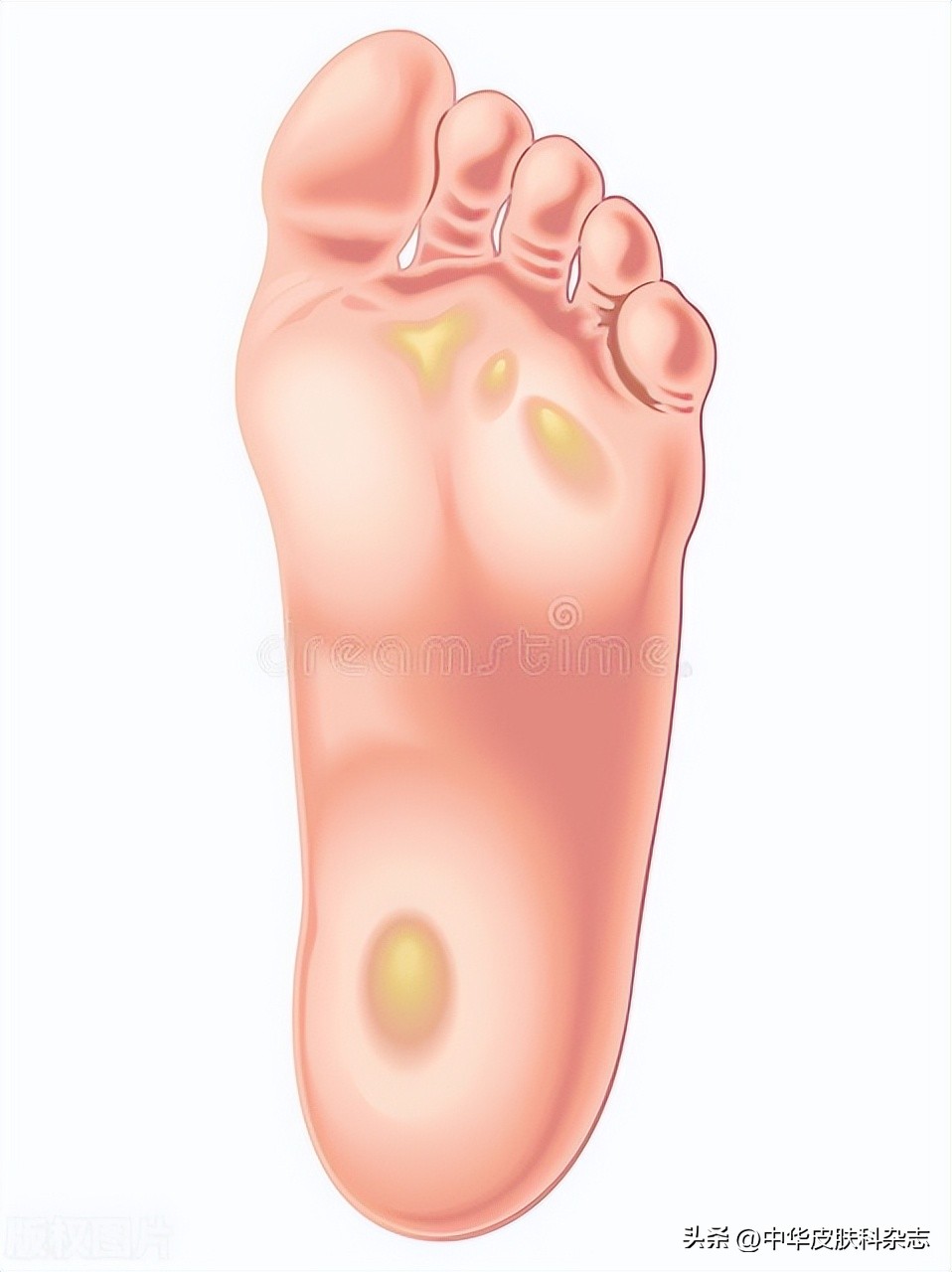 跖疣与鸡眼与胼胝的鉴别表格,鸡眼和跖疣还有胼胝的区别