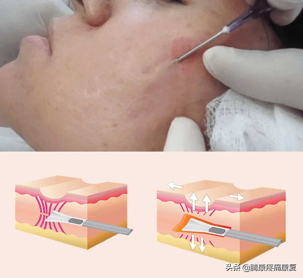 *疮痤**瘢痕的康复治疗