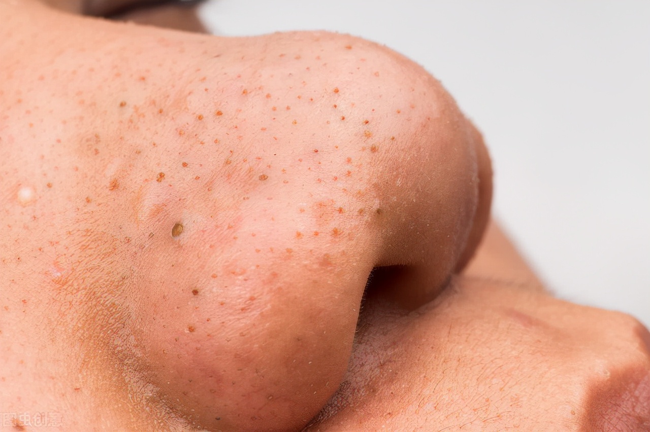 黑头白头在显微镜下怎么样,黑头可以挤出来是什么样子