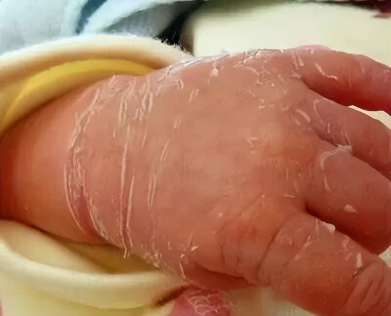 婴儿一激动就打嗝咋回事,胃胀打嗝放屁多体重下降