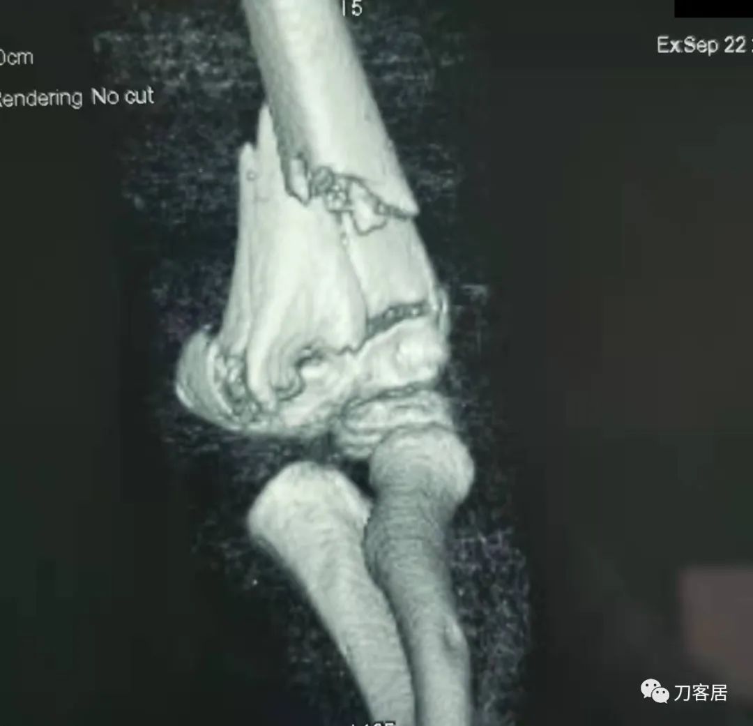 孩子胳膊摔伤肿了不能弯曲一直疼,9岁男孩摔倒手臂痛怎么办