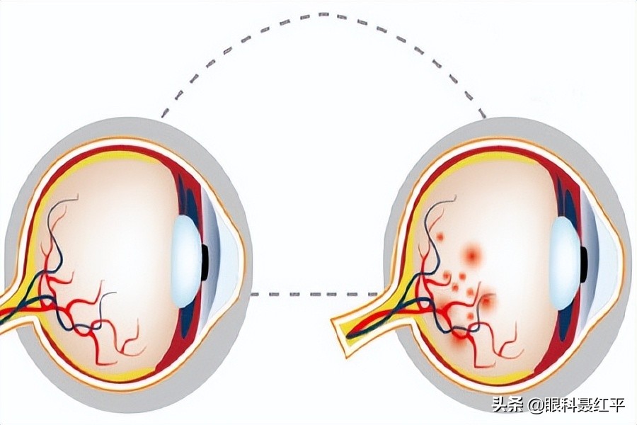 高血压眼底出血打针6000一针,高血压眼底出血视力模糊能恢复吗
