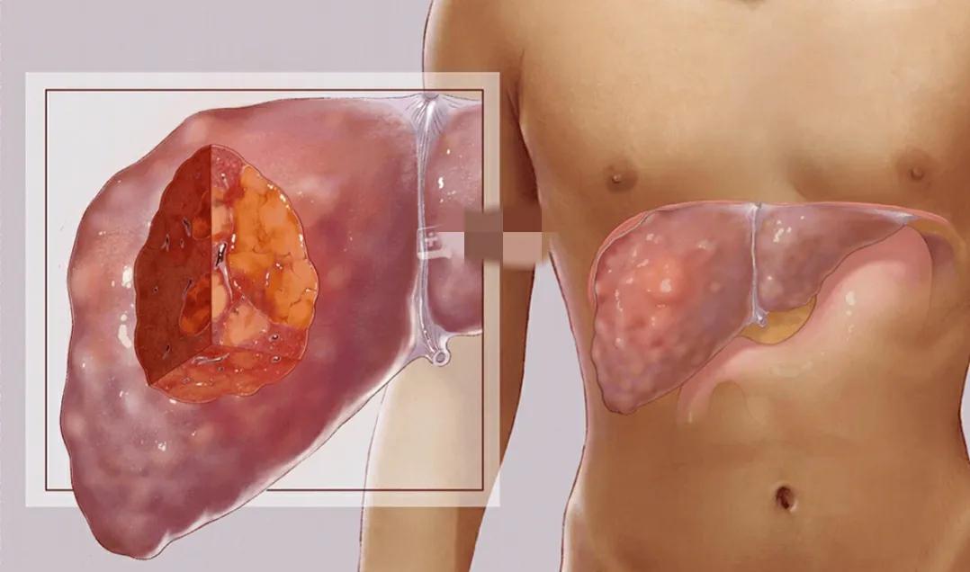 肝内血管瘤和肝癌超声怎么区分,肝占位病理检测项目