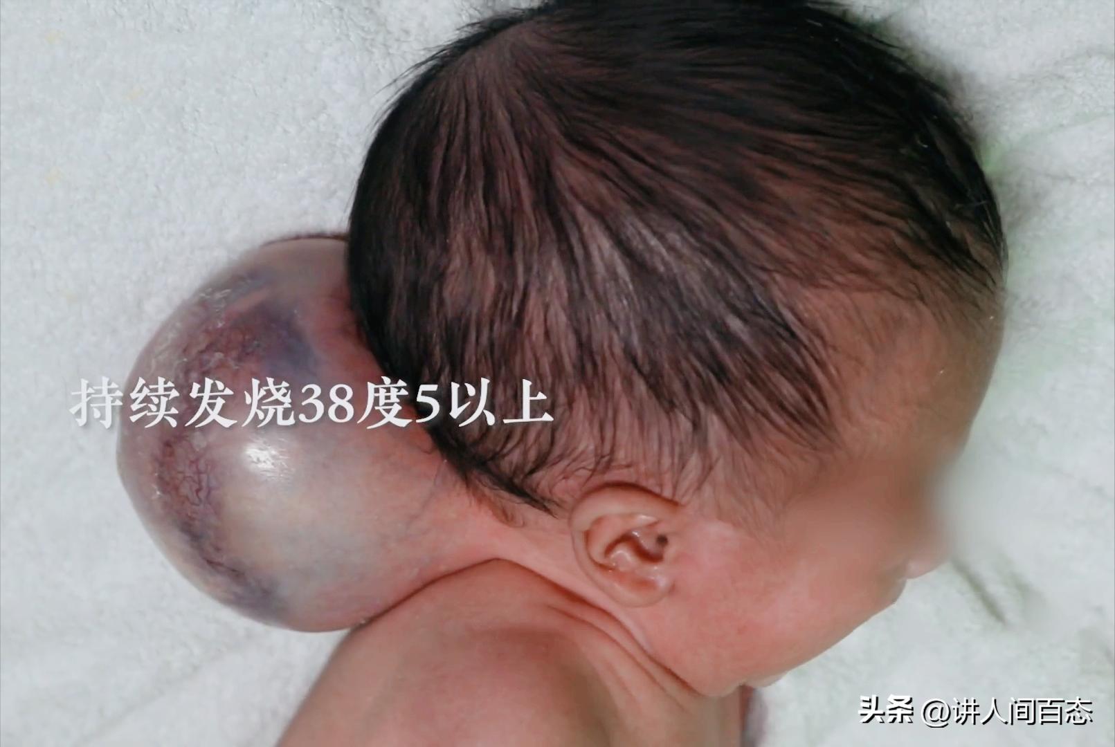 被丢在桥洞下的孩子后续,孩子被遗弃后脑长肿瘤